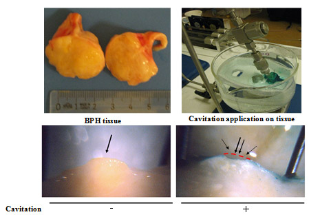 Figure 4: Cavitation on Benign Prostatic Hyperplasia